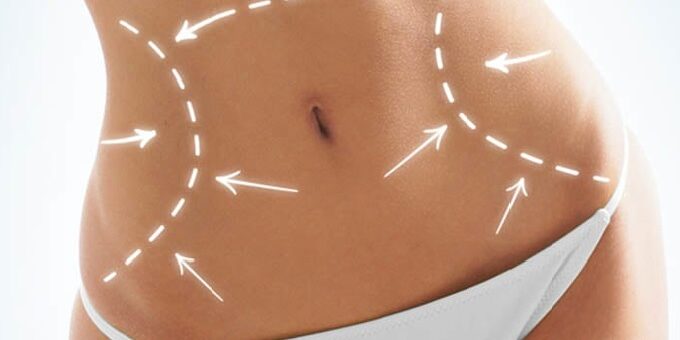 tummy-tuck