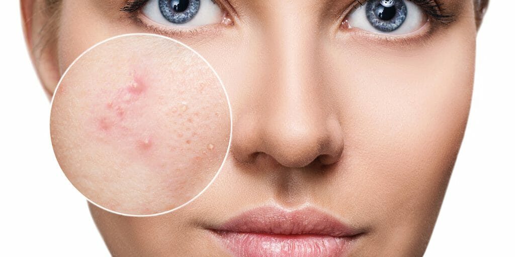 trattamenti acne