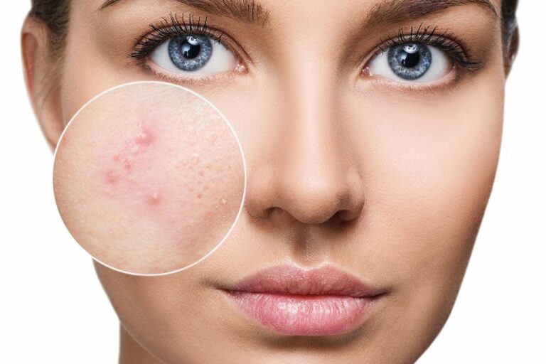 trattamenti acne
