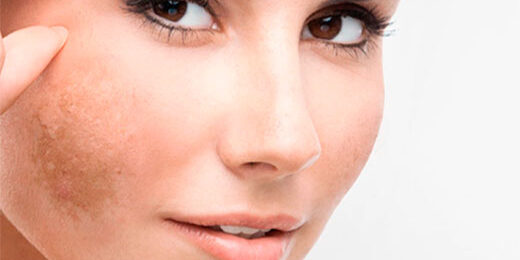 rimozione macchie viso lugano