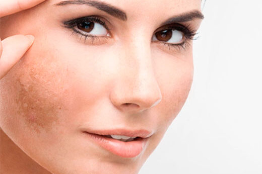 rimozione macchie viso lugano