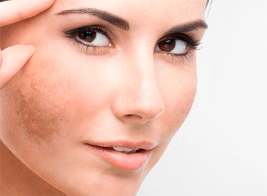 rimozione macchie viso lugano