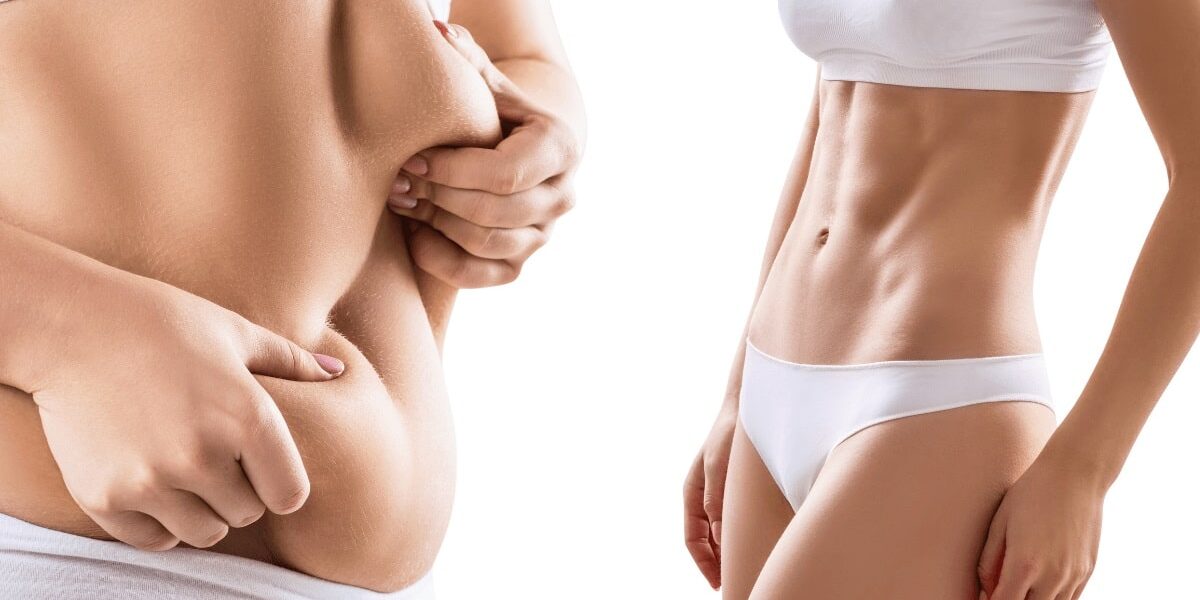 body-sculpting-e-Body-contouring-3
