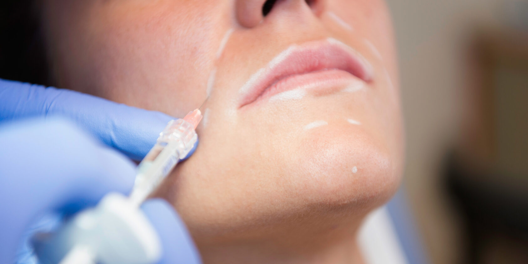 Collagen injection treatment