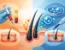 PRP o esosomi capelli: quale scegliere?