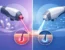 Laser Alessandrite vs diodo: quale scegliere?