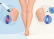 Laser vascolare versus scleroterapia: quale scegliere?